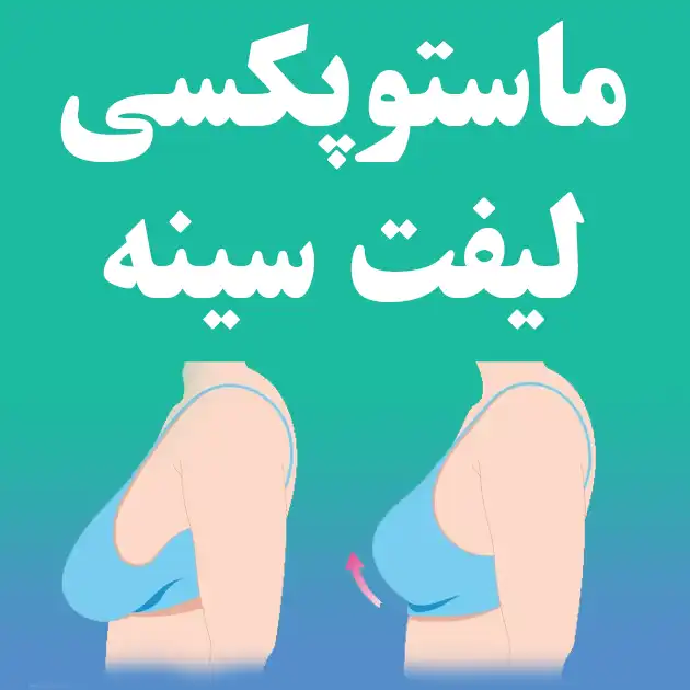 ماستوپکسی لیفت سینه