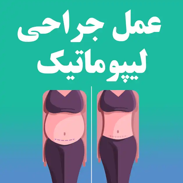 عمل جراحی لیپوماتیک