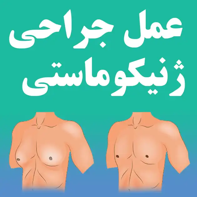 عمل جراحی ژنیکوماستی