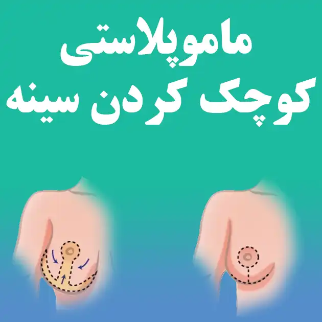 ماموپلاستی کوچک کردن سینه