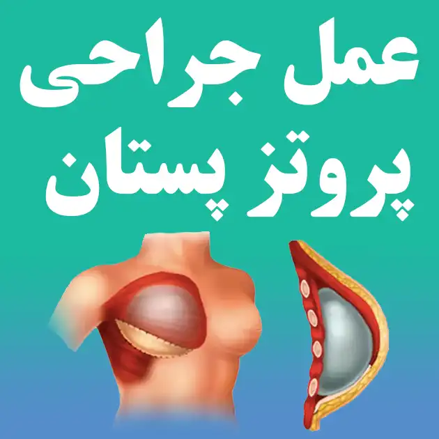 عمل جراحی پروتز پستان