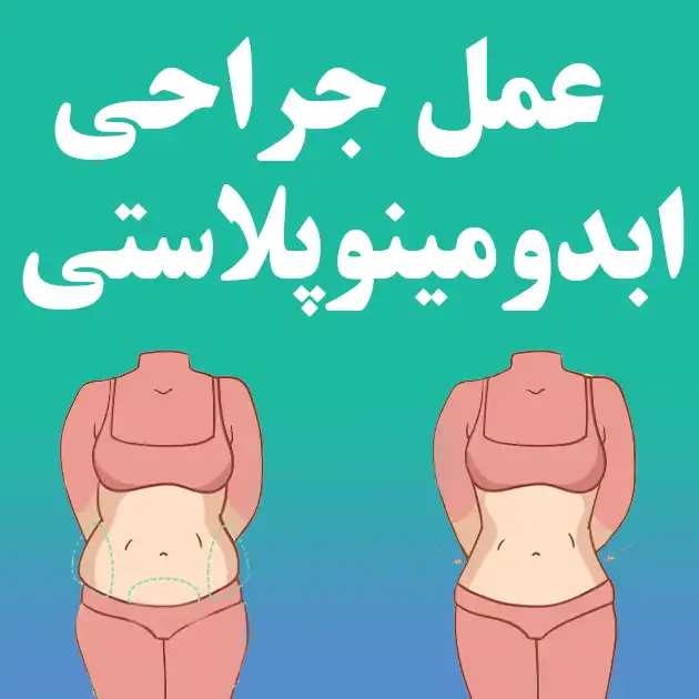 عمل جراحی ابدومینوپلاستی