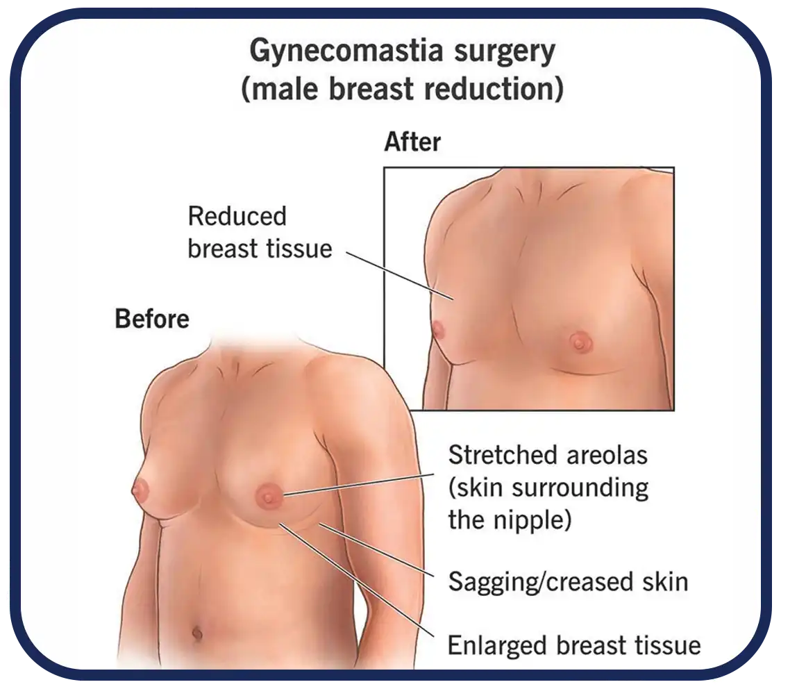 جراحی ژنیکوماستی
