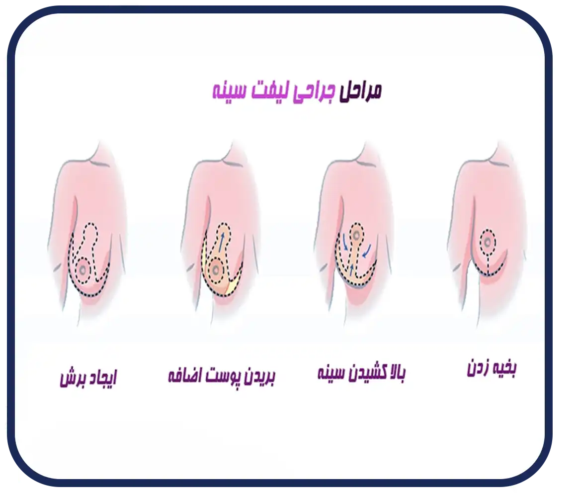 لیفت سینه یا ماستوپکسی