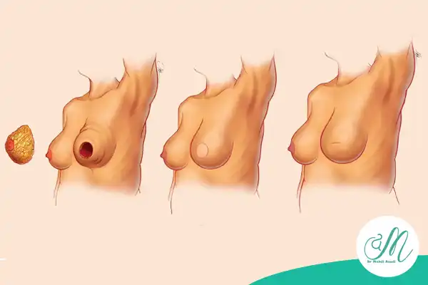 مراحل و روش‌های بازسازی پستان