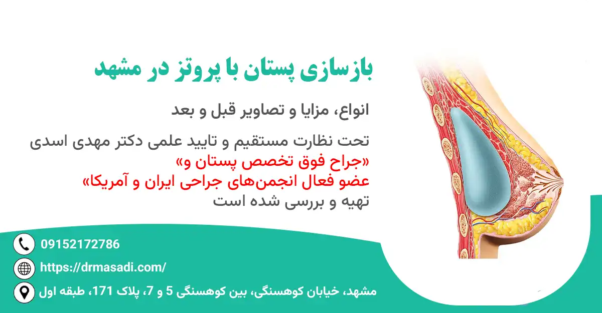 بازسازی پستان با پروتز