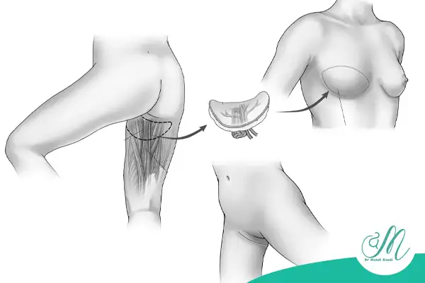 معایب و محدودیت‌های بازسازی پستان با چربی بدن