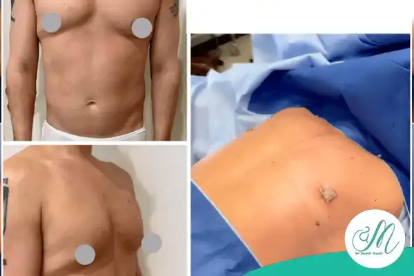 چگونه جراحی ژنیکوماستی انجام می‌شود؟