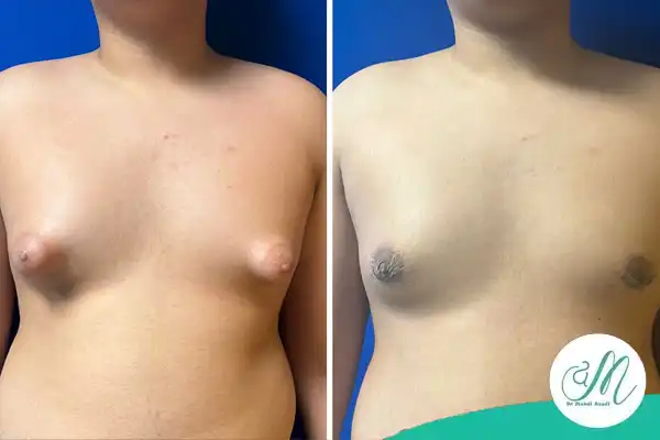 لیپوساکشن یا برداشت غده در ژنیکوماستی