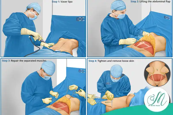 آیا ابدومینوپلاستی جایگزین لاغری است؟