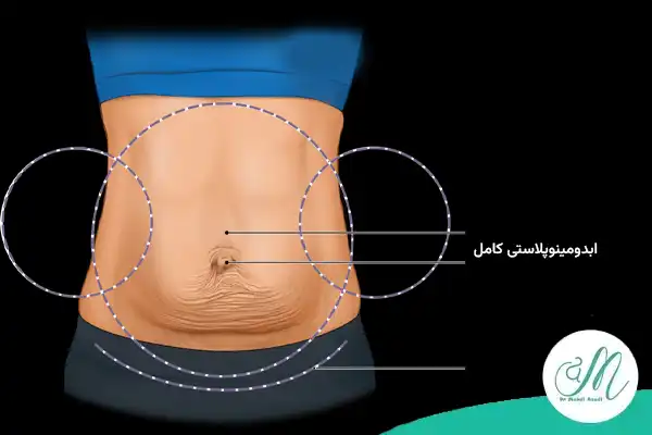 ابدومینوپلاستی کامل